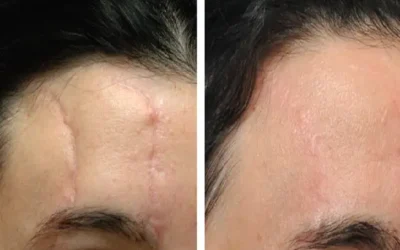 Plastic surgery for scars