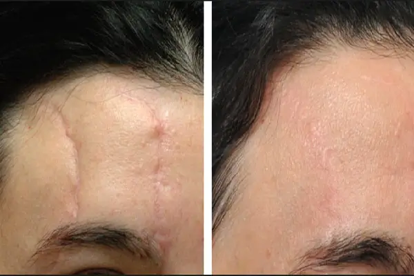 Plastic surgery for scars