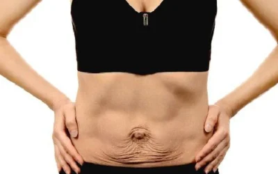 How to tighten your loose belly skin after weight loss?